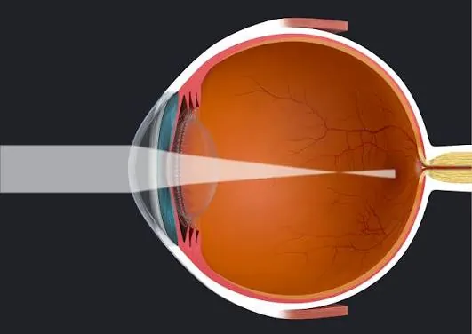 Refractive Errors